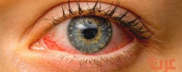 مرض العين في المنام