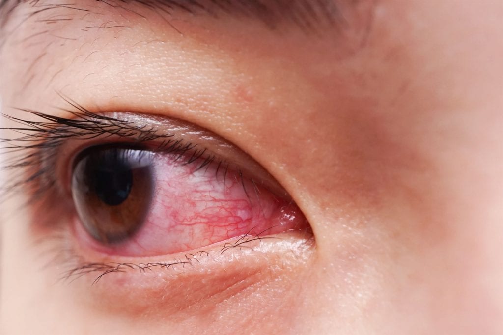 أعراض جفاف العين والصداع