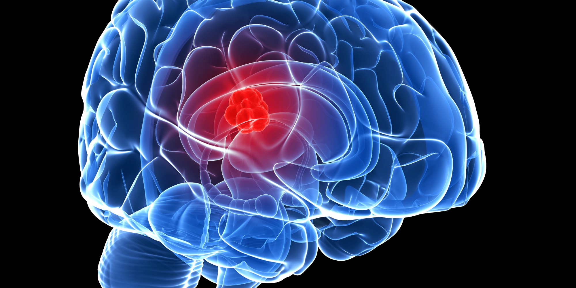 هل يشفي مريض سرطان الدماغ؟