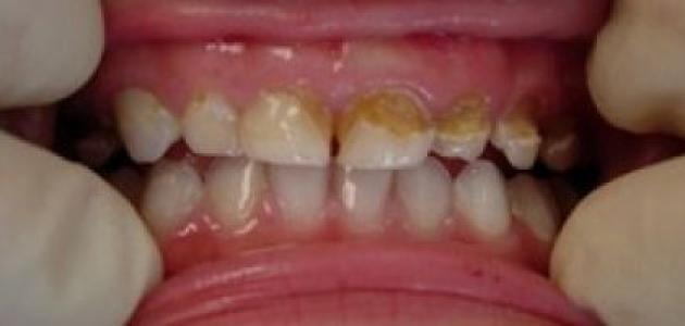 علاج الأسنان المتآكلة عند الأطفال