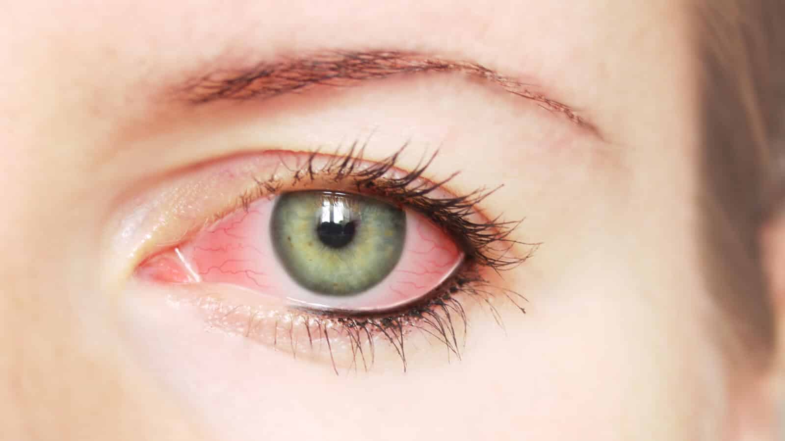 ما هي أسباب ألم العين عند تحريكها؟